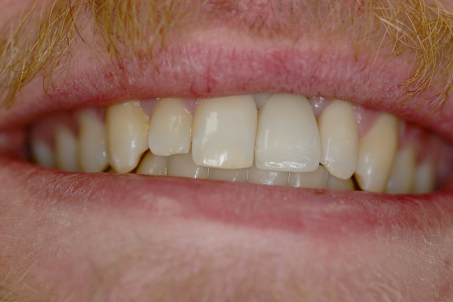 After Dental Implants