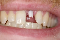 Dental Implants in Wheeling wv