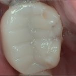 CEREC Ceramic Restoration in wheeling wv