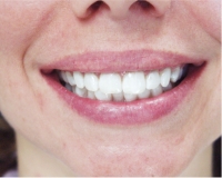 Zambito Teeth whitening in wheeling wv