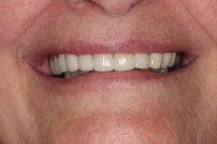 Dental crowns in wheeling wv