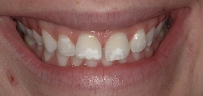 Before Cosmetic Dentistry