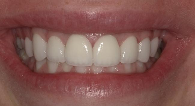 After Cosmetic Dentistry