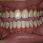 Invisalign in wheeling wv