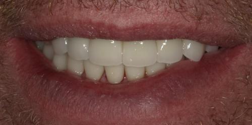 Full Mouth Rehab2- after