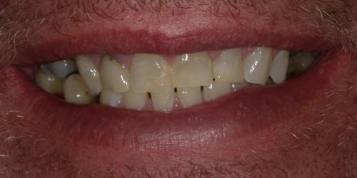 Full Mouth Rehab2 - before