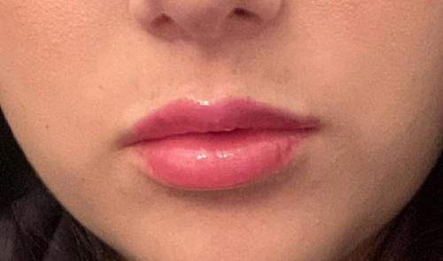 After JUVEDERM VOLBELLA