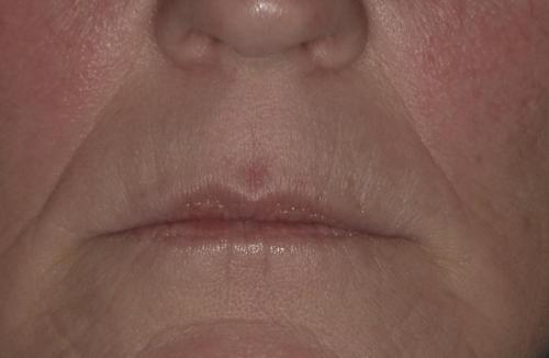 Before JUVEDERM filler and VOLBELLA Lips