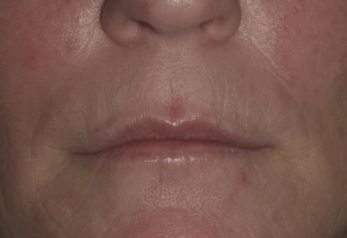 After JUVEDERM filler and VOLBELLA Lips