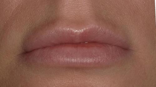 After JUVEDERM VOLBELLA