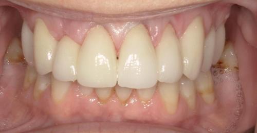 Crowns: After