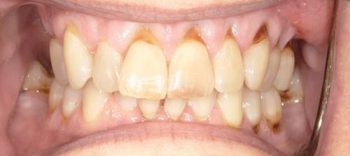 Crowns: Before